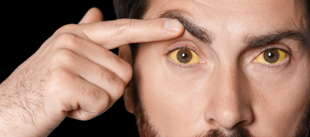 yellow eye in jaundice
