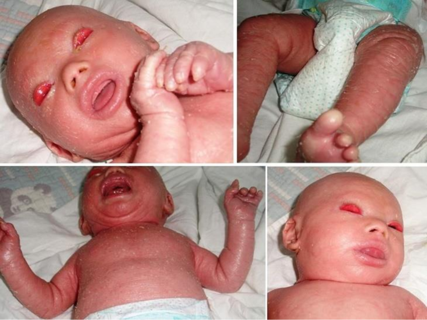 Harlequin Ichthyosis