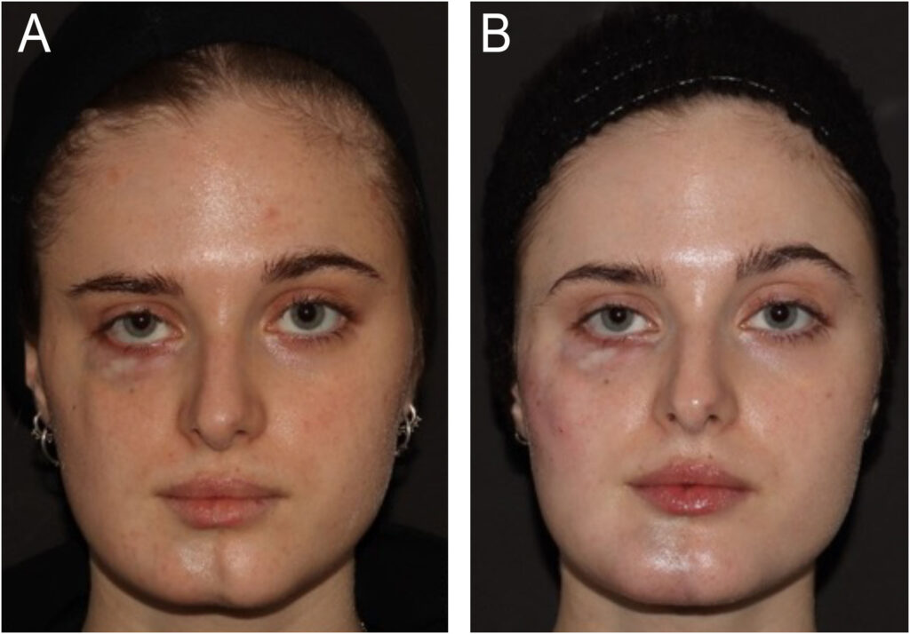 Parry-Romberg-Syndrome
